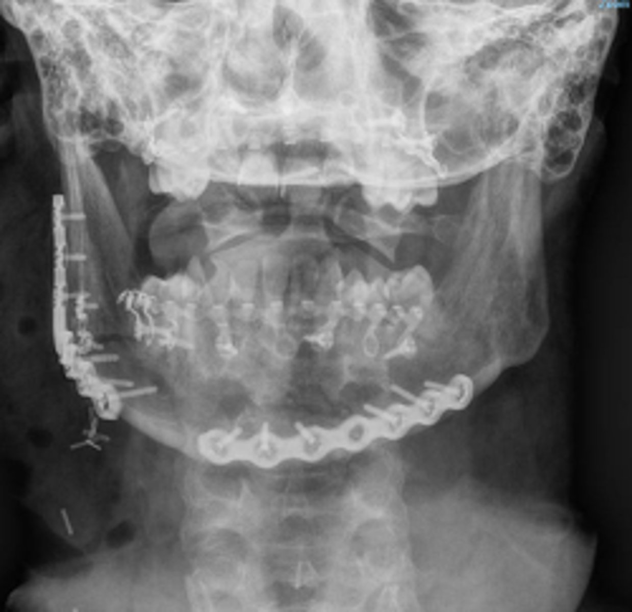 <p>This imaging modality is markedly less helpful than a PAN in many cases</p><p>•When taken intraoperatively, may have significant angulation concerns</p>