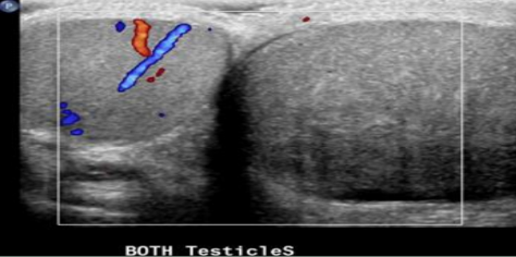 <p>signs/symptoms of torsion</p>