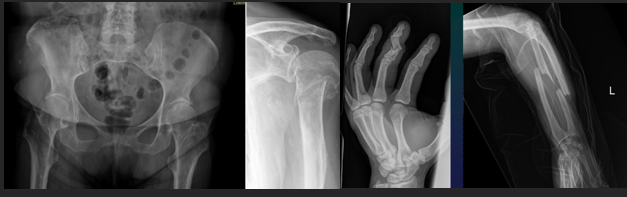 <ul><li><p>Lateral</p></li><li><p>Angulation</p></li><li><p>Rotation</p></li><li><p>Longitudinal (along the bone axis)</p><ul><li><p>Distancing</p></li><li><p>Intermission</p></li><li><p>AScent (straddling)</p></li></ul></li></ul><p></p>