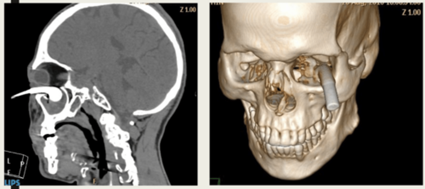 <p>high velocity injury</p>