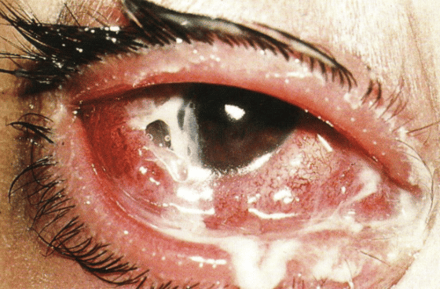 <p>What do we always need to rule out in a bacterial conjunctivitis, as shown here?</p>