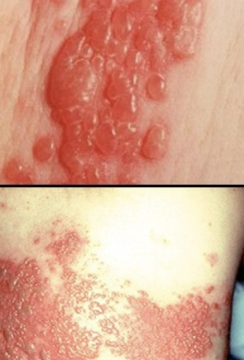 <p><span style="background-color: transparent;"><strong><span>Ebola and Marburg </span></strong></span></p>