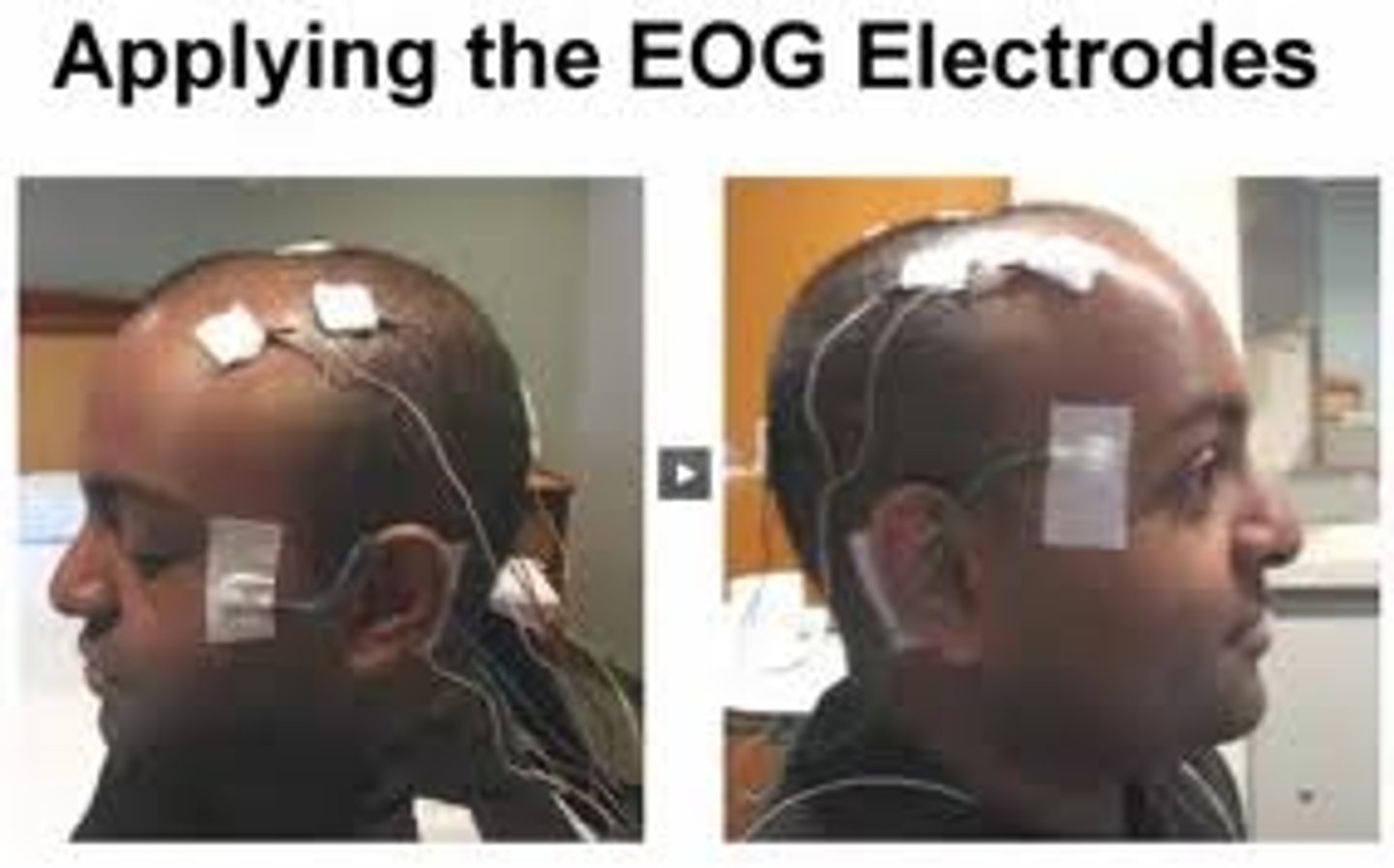 <p>measures eye movements; detects rem sleep through rapid movements.</p>