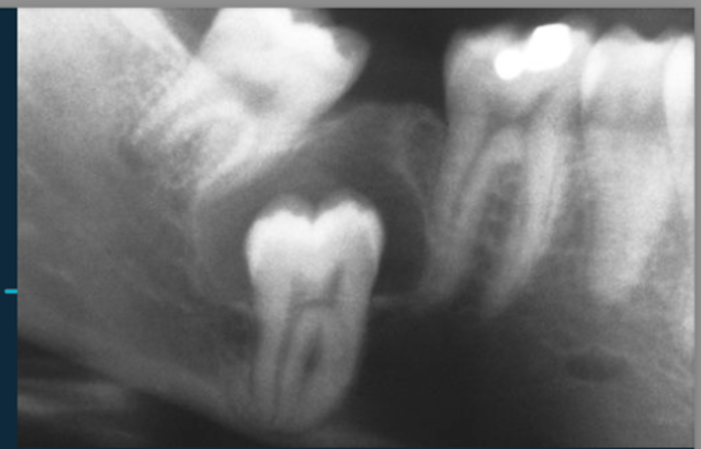<p>For benign radiographic characteristics, root resorption will look...</p>