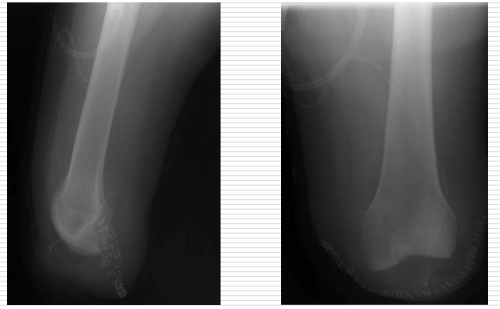<p>In the image there is not patella. </p><p>There is a procedure that you shave the sides of the distal femoral shaft in order to reduce the bulbous shape at the end of the femur.</p>