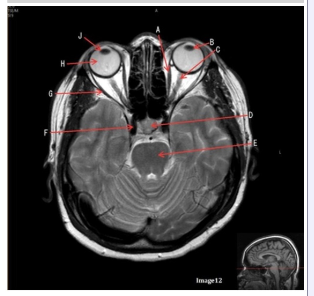 <p><span>&nbsp;&nbsp;Letter B in Image 12 is pointing to:</span></p><p><span>&nbsp;A. Left optic nerve</span></p><p><span>&nbsp;B. Lateral rectus muscle</span></p><p><span>&nbsp;C. Medial rectus muscle</span></p><p><span>&nbsp;D. Lens</span></p><p><span>&nbsp;E. Midbrain</span></p>