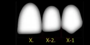 <p>Centra incisor= X</p><p>Lateral incisor = X-2mm</p><p>Canine = X-1mm</p><p></p>