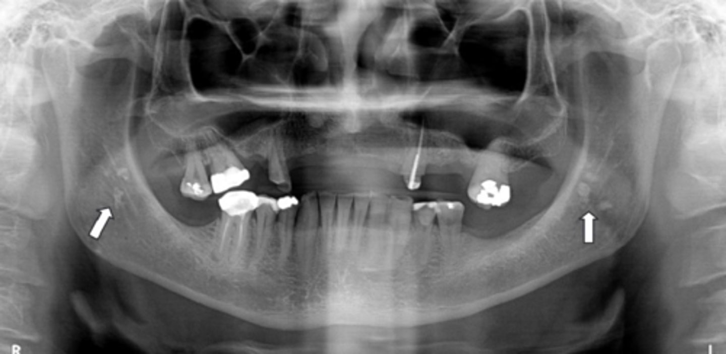 <p>Oropharyngeal air space</p>