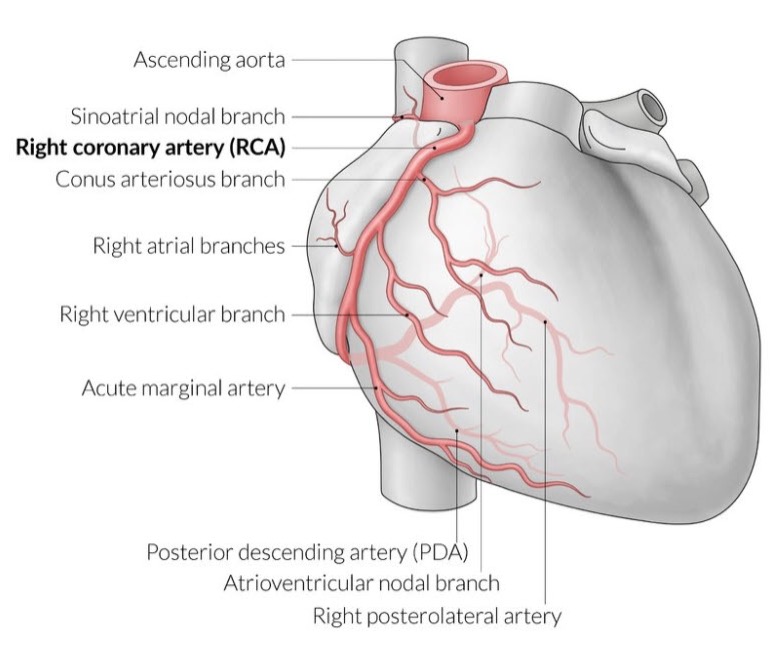 <p>posterior descending artery (PDA)</p><ul><li><p><strong>Right Dominance (70-85% of people)</strong>:</p><ul><li><p><strong>(PDA)</strong> originates from the <strong>right coronary artery (RCA)</strong>.</p></li><li><p>The right coronary artery supplies both the PDA and the posterior part of the heart.</p></li></ul></li><li><p><strong>Left Dominance (10-15% of people)</strong>:</p><ul><li><p>The PDA originates from the <strong>left circumflex artery (LCx)</strong>, a branch of the <strong>left coronary artery (LCA)</strong>.</p></li><li><p>The left coronary artery thus supplies most of the heart, including the posterior portion.</p></li></ul></li><li><p><strong>Co-Dominance (5-10% of people)</strong>:</p><ul><li><p>The PDA receives contributions from both the <strong>right coronary artery</strong> and the <strong>left circumflex artery</strong>.</p></li><li><p>Both arteries share responsibility for the blood supply to the posterior part of the heart.</p></li></ul></li></ul><p></p>