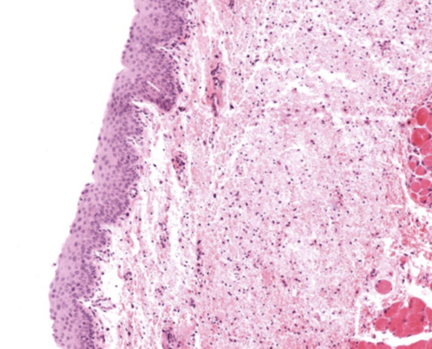 <p>Stratified squamous non-keratinized epithelium</p><p>so we can speak if we had any other lining the voice will be distorted</p>