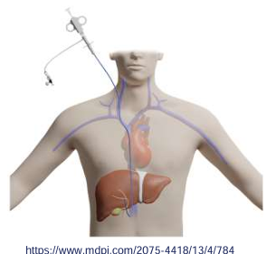 <ul><li><p>no exact etiology based on lab and imaging tests but</p><ul><li><p>specific treatment or conduct can be decided ( AH, DILI, viral infection, mushroom, Wilsons, malignancy)</p></li></ul></li><li><p>to distinguish ALF from chronic liver disease</p></li><li><p>Transjugular apprach is prefered </p></li></ul><p></p>