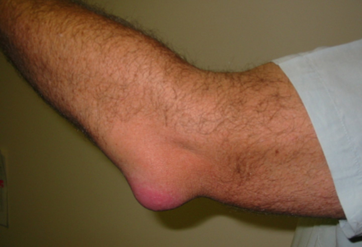 <p>-student's elbow, elbow bursitis</p><p>-swelling over posterior elbow</p>