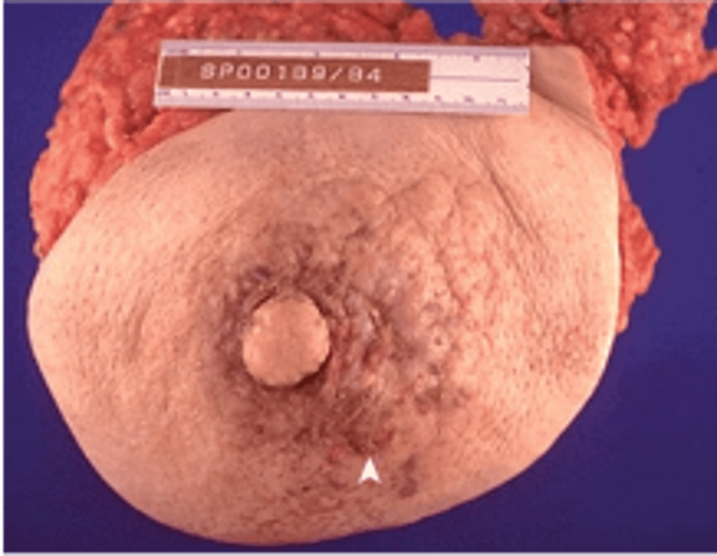 <p>Define Type of Breast Cancer:</p><p>Tumor cells invading the dermal lymphatics</p><p>-Sx/PE:</p><p>&gt; Breast Pain</p><p>&gt; Warm, Swollen, Red/Inflamed skin around exaggerated hair follicles giving "Peau d'orange" appearance (orange peel texture)</p><p>-Prog: POOR!</p>