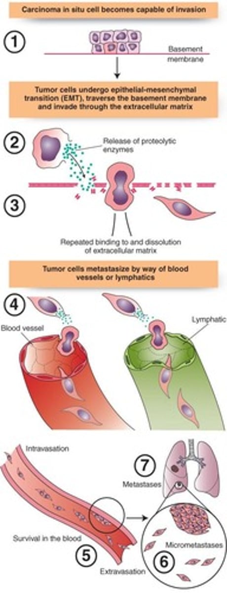 <p>Spread of cancer to distant sites.</p>