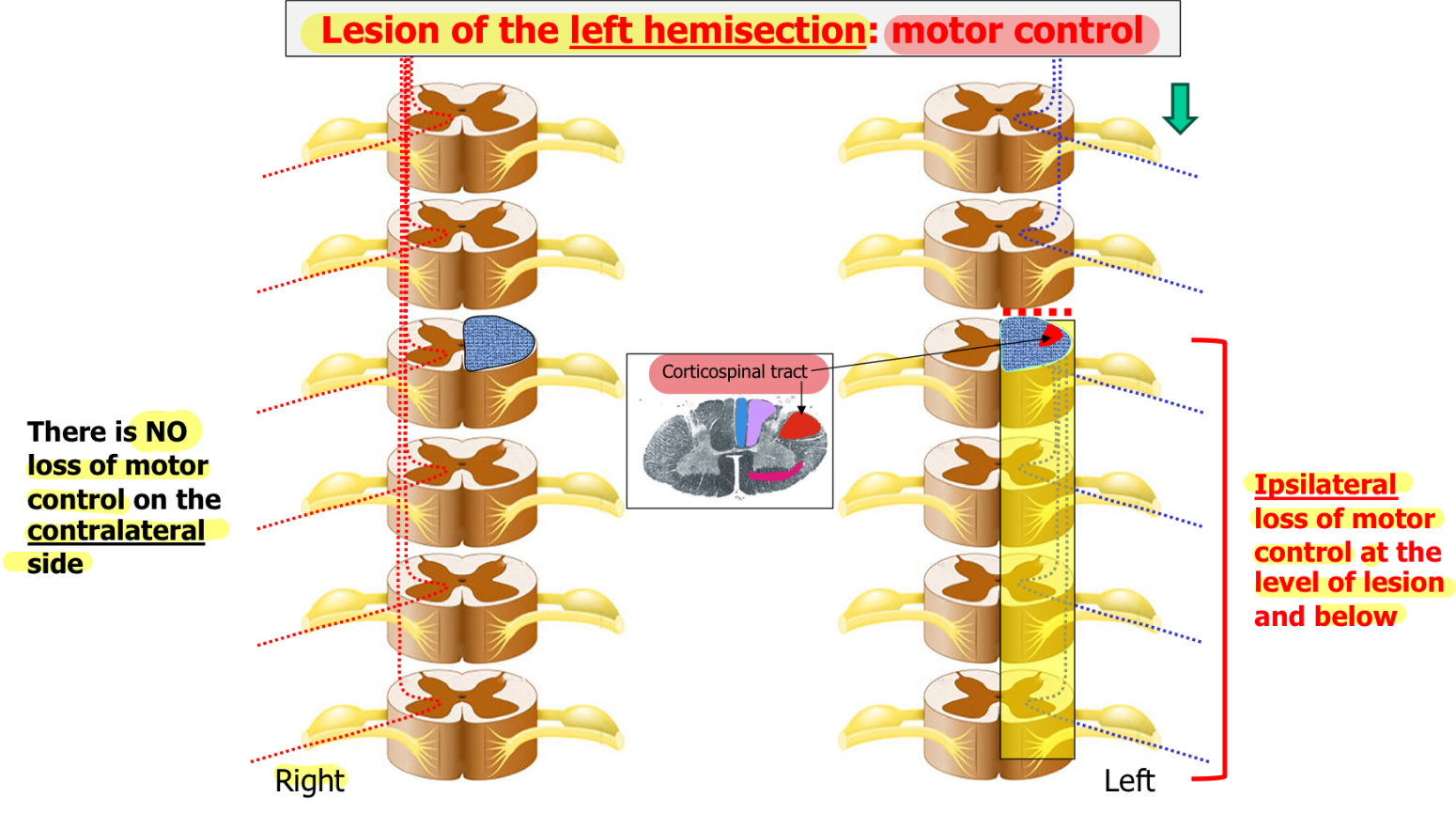 <p><u>Ipsilateral</u> =&gt; loss of motor control at the level of lesion and below</p><p><u>Contralateral</u> =&gt; NO loss of motor control</p>