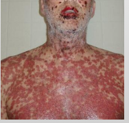 <ul><li><p>Almost Always triggered by <strong>drugs (medication)</strong></p></li><li><p><strong>&lt;10% of body surface is affected</strong></p></li><li><p>Younger</p></li><li><p>Initially on trunk</p></li><li><p>Sever sloughing of skin</p></li></ul><p></p>