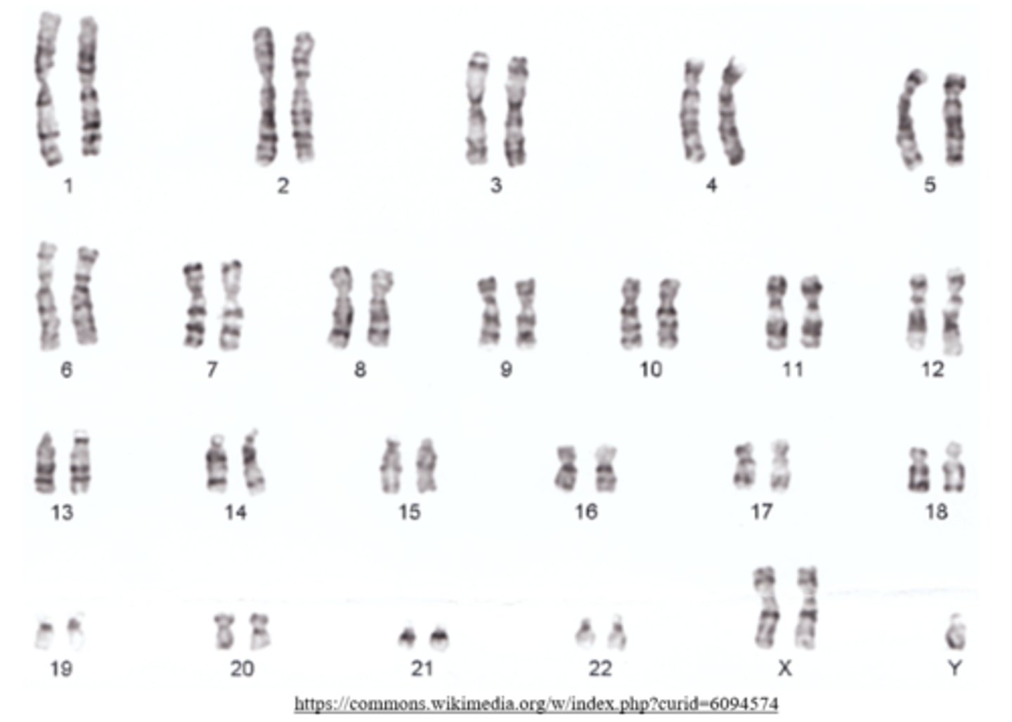 <p>Klinefelter syndrome</p>