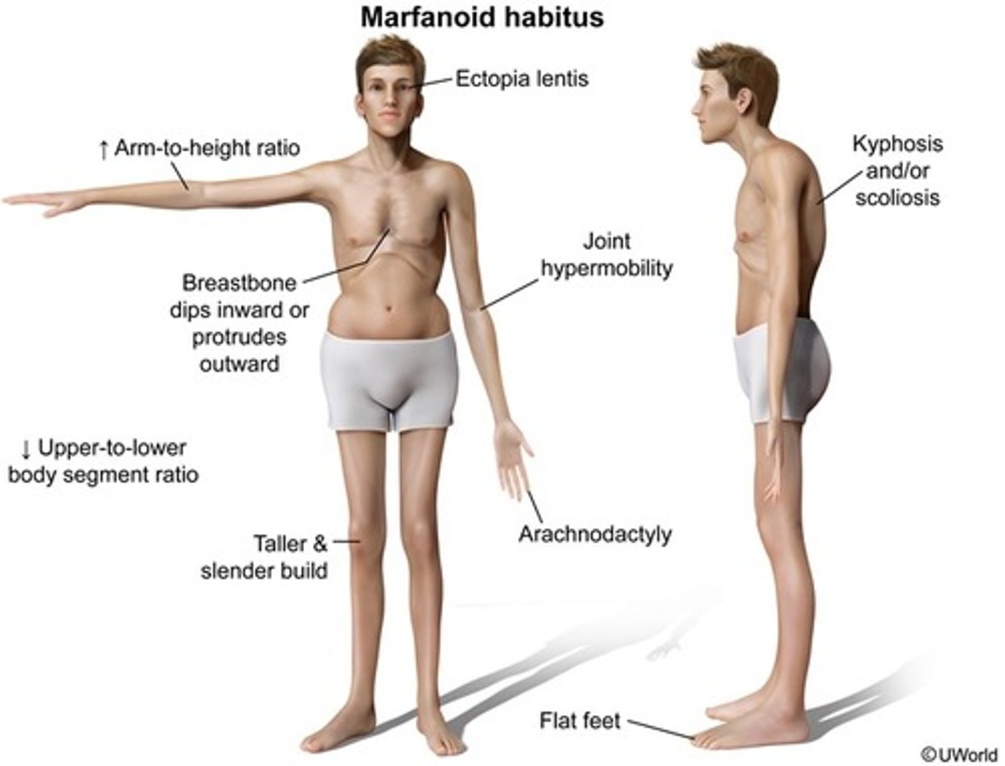 <p>Inherited connective tissue disorder is characterized by tall, thin stature, arachnodactyly (long, thin fingers), hyperextensible joints, arm span greater than height, long legs, and sternal deformity</p>