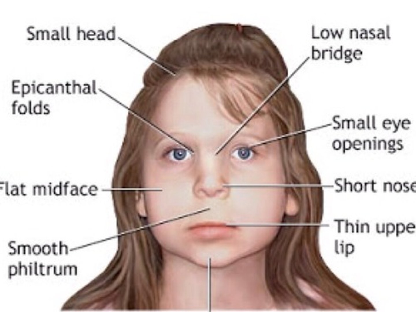 <p>born underweight, deficient growth, and malformations of the skull and face</p>
