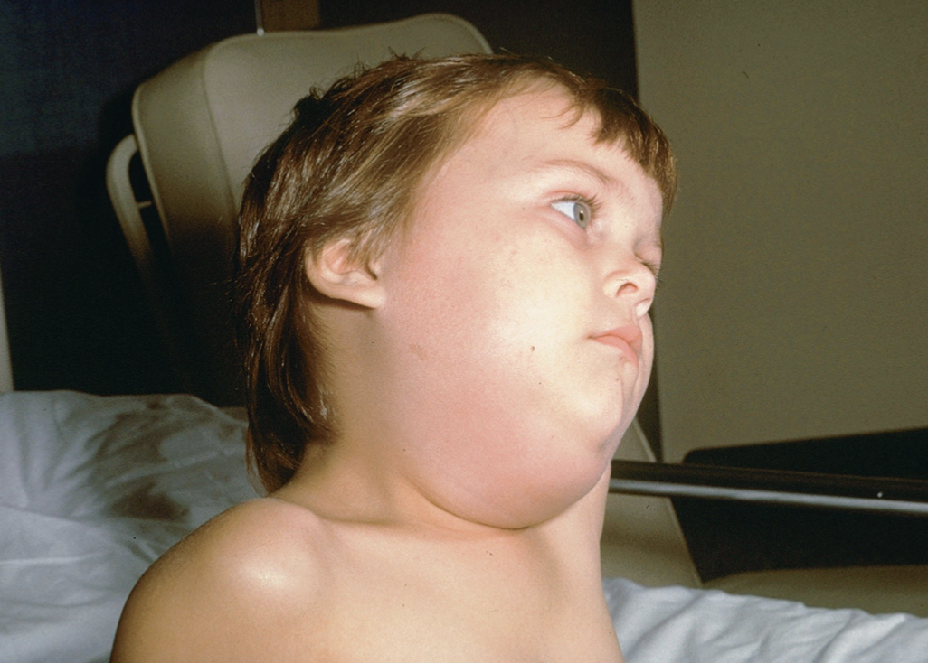 <ul><li><p>Enveloped, ssRNA</p></li><li><p> Cause of mumps or epidemic parotitis,<strong> a self- limiting systemic viral disease</strong></p></li><li><p> Transmission via <strong>droplets of infected saliva</strong></p></li><li><p> Symptoms: painful swelling of parotid glands, fever, headache, and sore throat</p></li><li><p> Pancreas, ovaries and testes can be infected</p></li><li><p><strong> Orchitis can lead to infertility</strong></p></li><li><p><strong>Photo shows mumps due to infection of the parotid or salivary glands by the virus. The resulting neck swelling is easily recognized.</strong></p><p></p></li></ul><p></p>