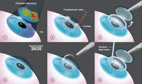 <p>Fem-to-sekund LASIK</p>