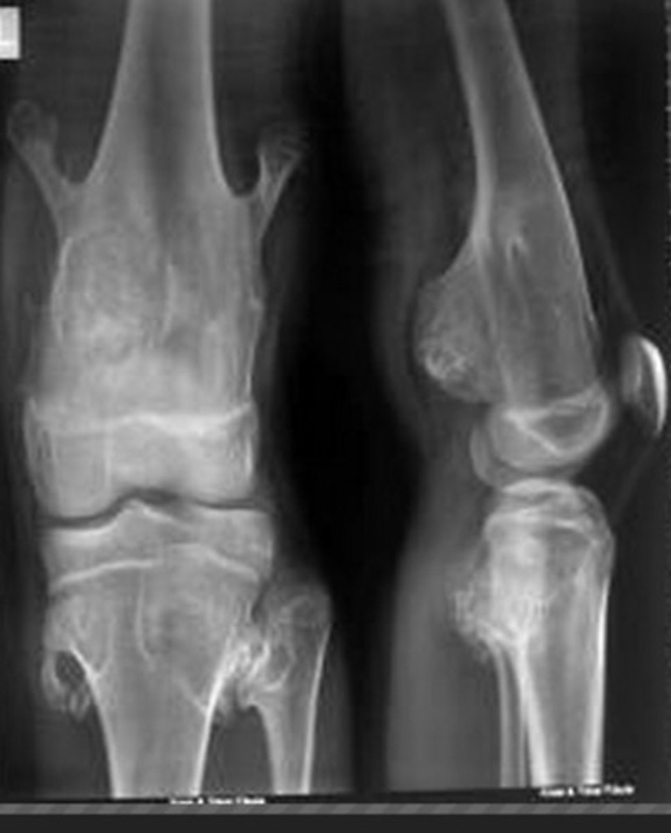 <p>Hereditary Multiple Exostosis (multiple hereditary osteochondroma)</p>