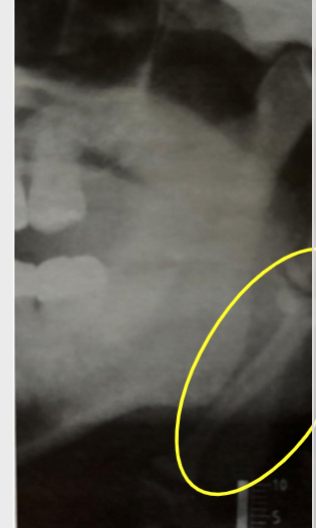 <p>elongation of styloid process or mineralization of stylohyoid ligament </p>