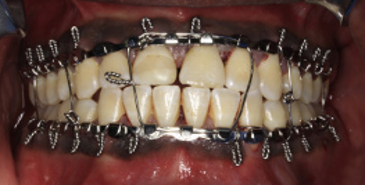 <p>ID the closed treatment/ maxillomandibular fixation:</p><p>•Allows for some movement during reduction</p><p>•24- or 26- gauge wire applied around the arch bar and the teeth</p>