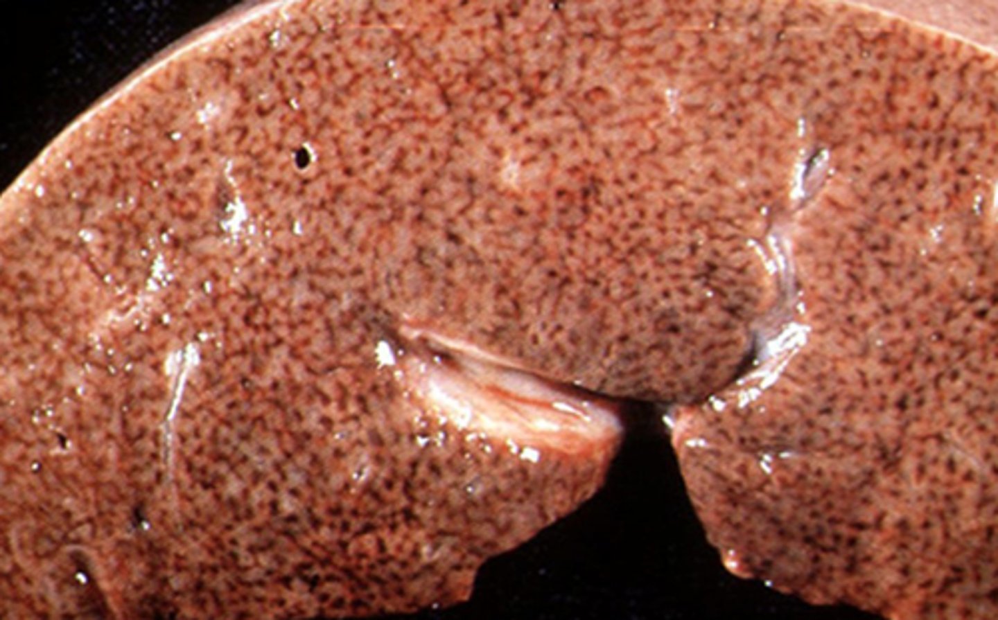 <p>Acute passive congestion of the liver with centrilobular hemorrhagic necrosis secondary to right heart failure is also called:</p>