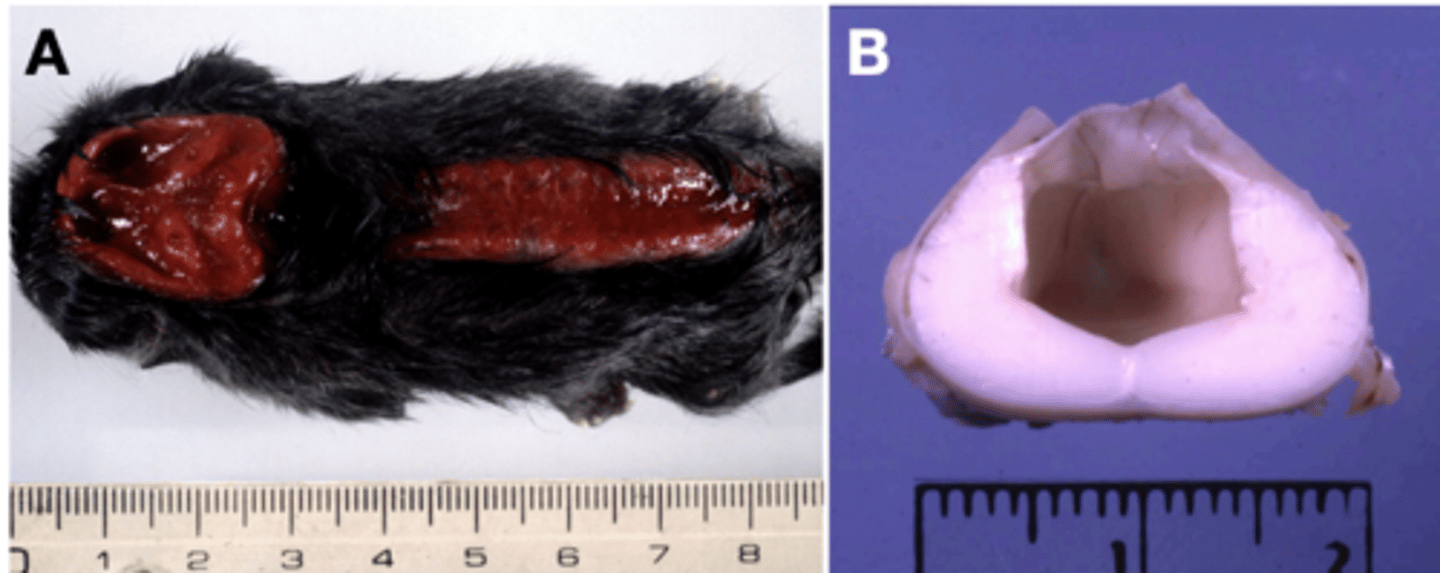<p>- In the brain: Anencephaly, encepahlocele, meningecele, meningoencephalocele</p><p>- In the cord: Spina bifida (Amyelia (A), hydromelia (B), Meningomyelocele, dermois sinus)</p>