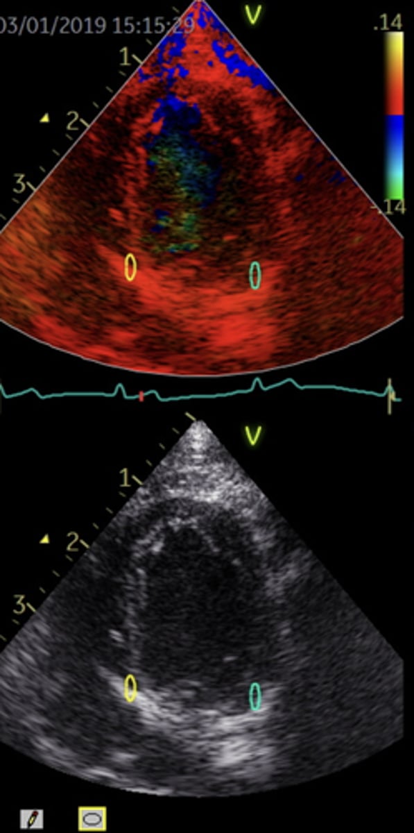 <p>Myocardial motion & velocities represented by color on 2D image</p>