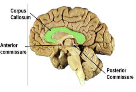 <ul><li><p>Also known as epithalamic commissure</p></li><li><p>Located near the <strong>cerebral aqueduct</strong> (where CSF flows between the 3rd and 4th ventricles).</p></li><li><p>Important for the bilateral <strong>pupillary light reflex</strong> (how your pupils react to light).</p></li></ul><p></p>