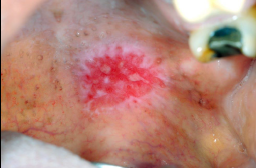 <p><span style="color: blue;"><strong><em><u>PRE-MALIGNANT NEOPLASMS</u></em></strong></span></p><p>Erythroplakia</p><ul><li><p>Clinical Signs</p></li><li><p>Location</p></li><li><p>Etiology</p></li><li><p>Treatment</p></li></ul><p></p>