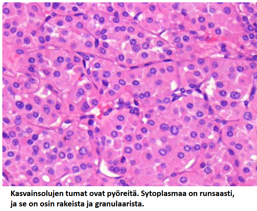 <p><strong><u>MIKÄ TAUTI? </u></strong> Kasvainsolujen tumat ovat pyöreitä. Sytoplasmaa on runsaasti, ja se on osin rakeista ja granulaarista.</p>