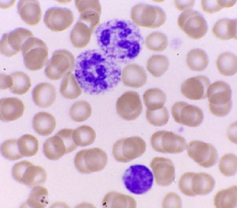 * inherited(cytoplasmic)
* Cytoplasmic granulation helps ID issue
* Rare lysosomal trafficking or storage disorders
  * Generally systemic dysfunction, physical abnormalities
  * Can affect lymphocytes too
* Lysosomal defects; mucopolysaccharidoses (MPS)
* Clinical manifestations are generally readily apparent