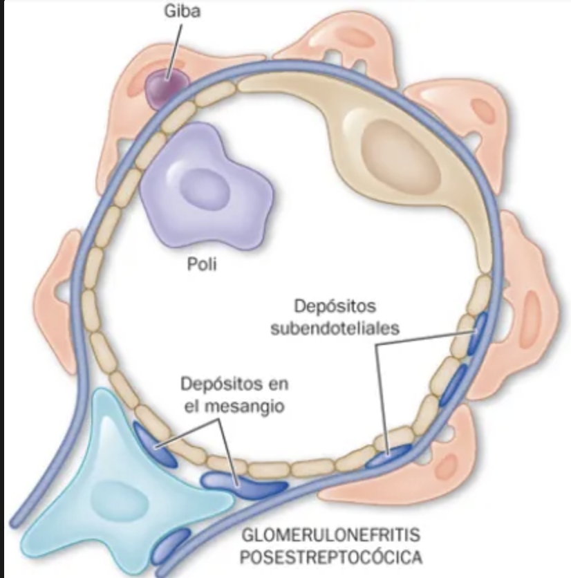 <ul><li><p>Cepas de estreptococus B-hemolíticos del grupo A</p><ul><li><p>Tipos 12, 4 y 1 tipificados por la <strong>proteína M</strong></p></li><li><p><strong>Exotina piógena estreptocócica B (</strong>SpeB<strong>): activan el complemento.</strong></p></li><li><p><strong>NAP1r: </strong>Receptor de plasmina asociado a nefritis</p></li></ul></li></ul><p></p><p>Estos antígenos se implantan en las <strong>paredes subendoteliales </strong>de los capilares glomerulares, induciendo la formación in situ de inmunocomplejos y desencadenando respuesta inflamatoria</p><p></p>