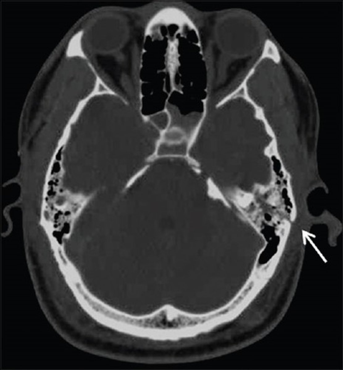 <p>linear fracture at the base of the skull</p>