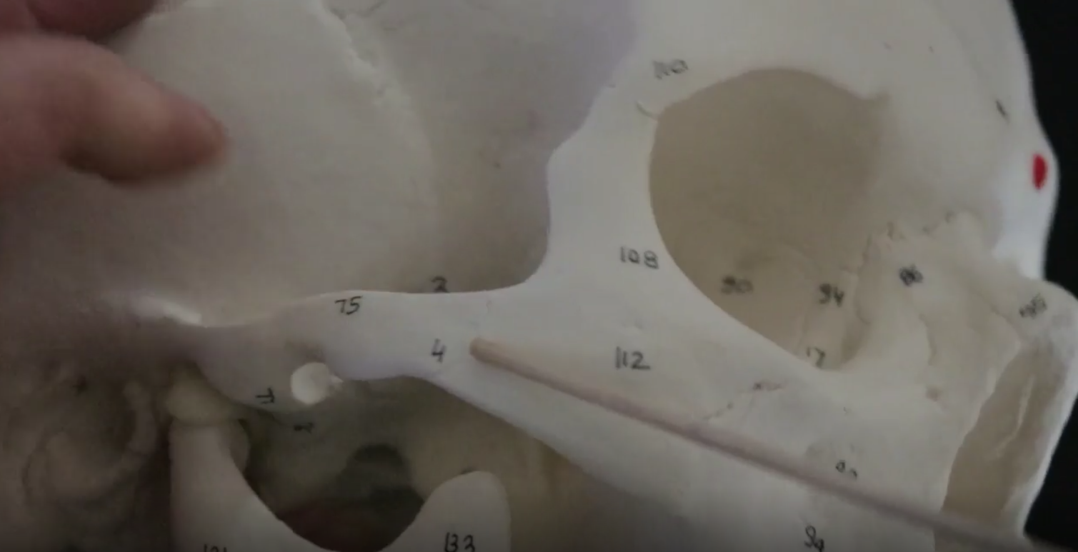 (past the #4)-NOT the zygomatic process of the temporal bone