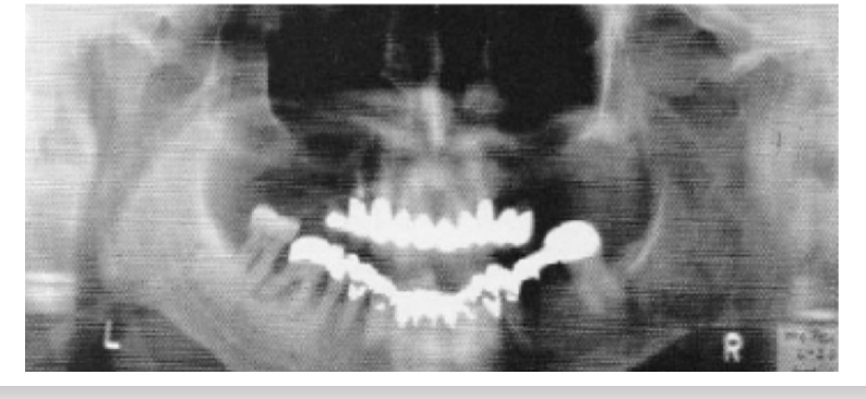 <p>Overlapping teeth, mandibular symphysis inferior border might not be visible, and both condyles appear over the upper limit of the image.</p>