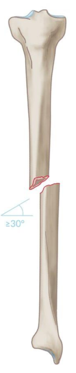 <p>what type of fracture is this?</p>