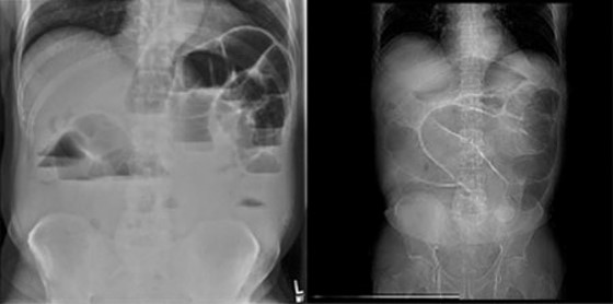<p>Transfer of cancerous lesion from one area to another</p>