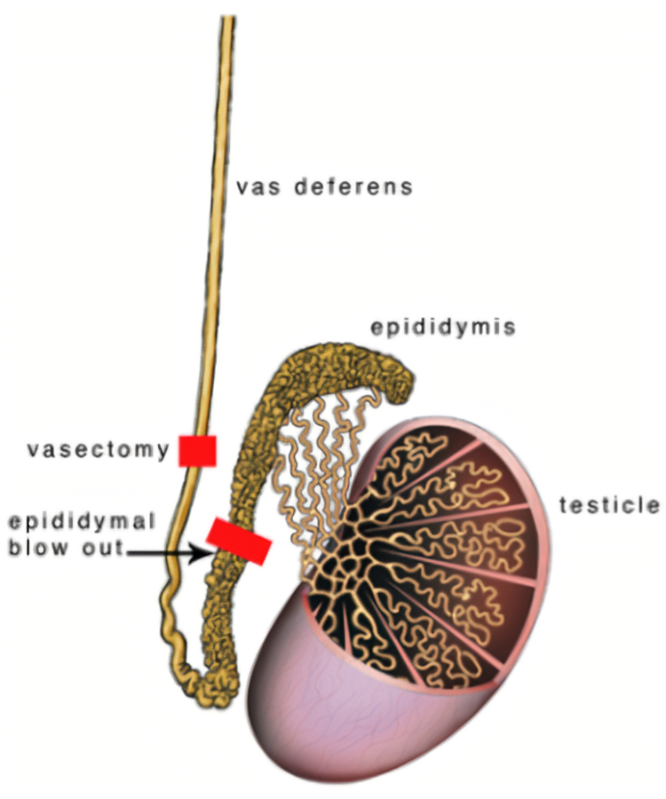 <p>A. ductus deferens</p><p><strong>ductus deferens (vas deferens)</strong> is <strong>ligated (cut and sealed)</strong>.</p><ul><li><p class="">prevents <strong>sperm from traveling from the testes to the urethra</strong>, making the man sterile</p><ul><li><p class=""><strong>ejaculatory duct</strong> is further downstream and is not directly cut.</p></li><li><p class="">The <strong>epididymis</strong> is where sperm matures but is not surgically manipulated in a vasectomy.</p></li><li><p class="">The <strong>fossa navicularis</strong> is part of the penile urethra, unrelated to sperm transport.</p></li><li><p class="">The <strong>seminal vesicle</strong> produces seminal fluid but does not carry sperm.</p></li></ul></li></ul><p></p>