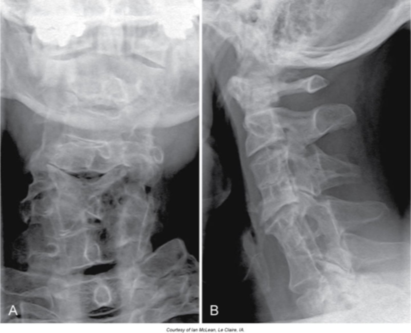 <p>Abnormality during fetal development - short neck (webbed), low hairline, and decreased range of motion of the cervical spine</p>