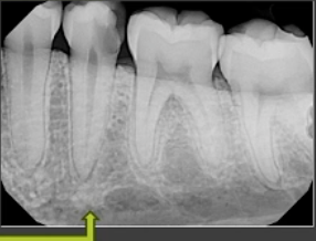 <p>what type of lesion is shown here </p>