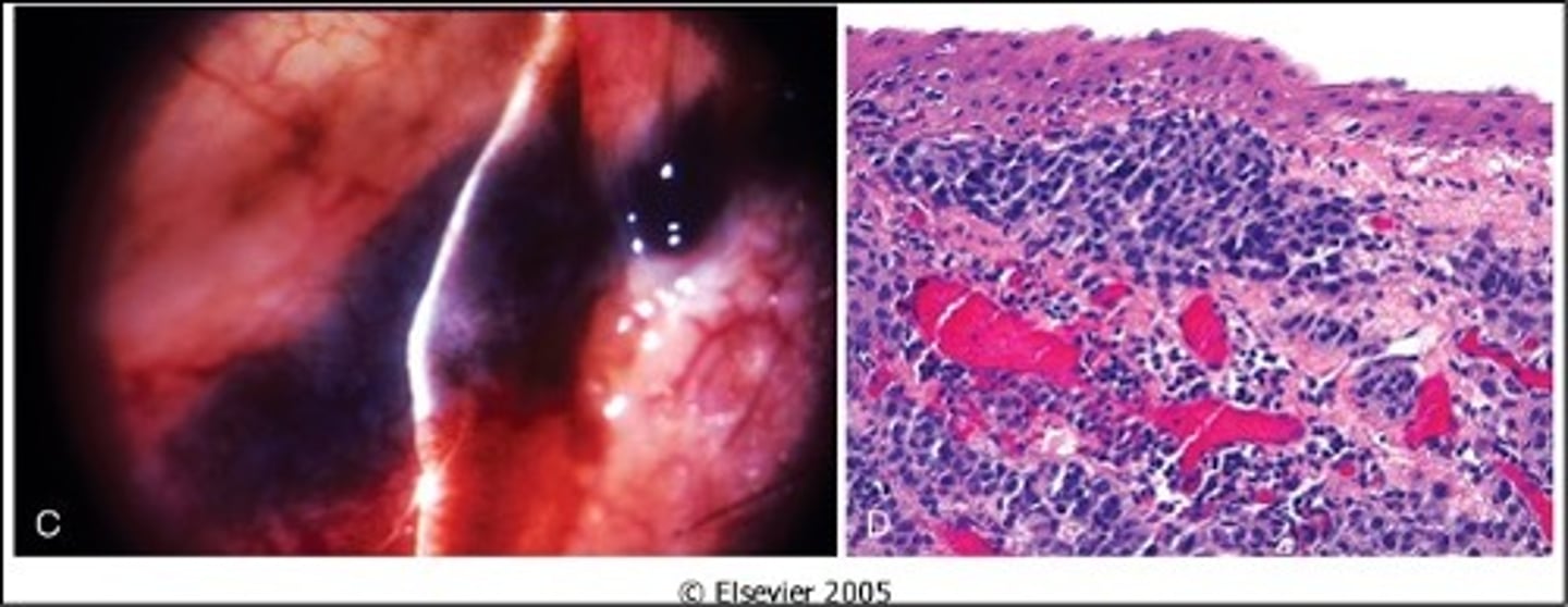 <p>Information for Condition:</p><p>Irregular growth in conjunctiva</p><p>Large &amp; atypical cells that invade stroma</p>