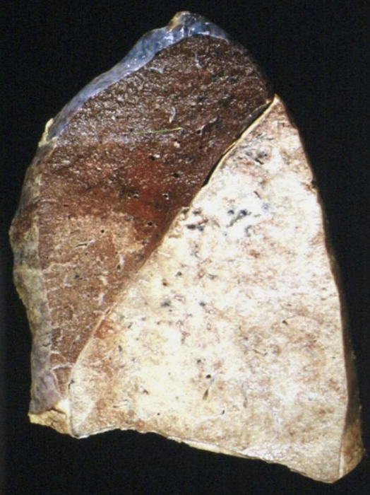 <p>Inflammation</p>