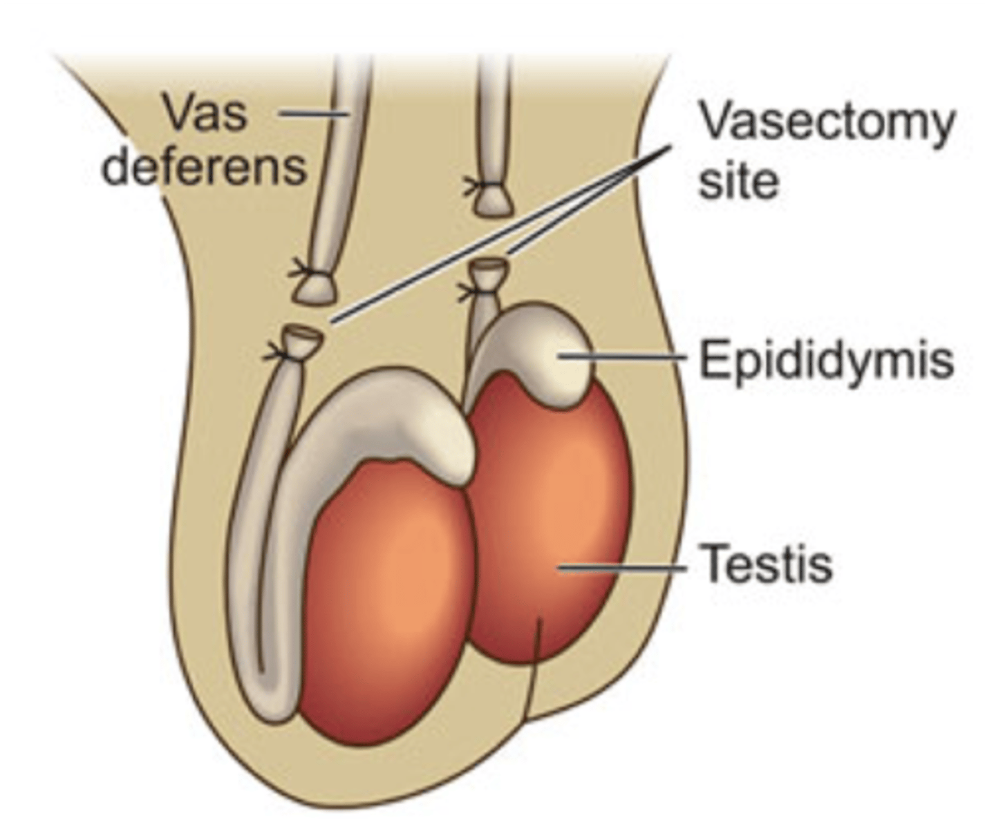 <p>surgical procedure that removes all or part of the deferens deferns that prevents sperm to travel through the urethra</p><p>-Permanent method</p>