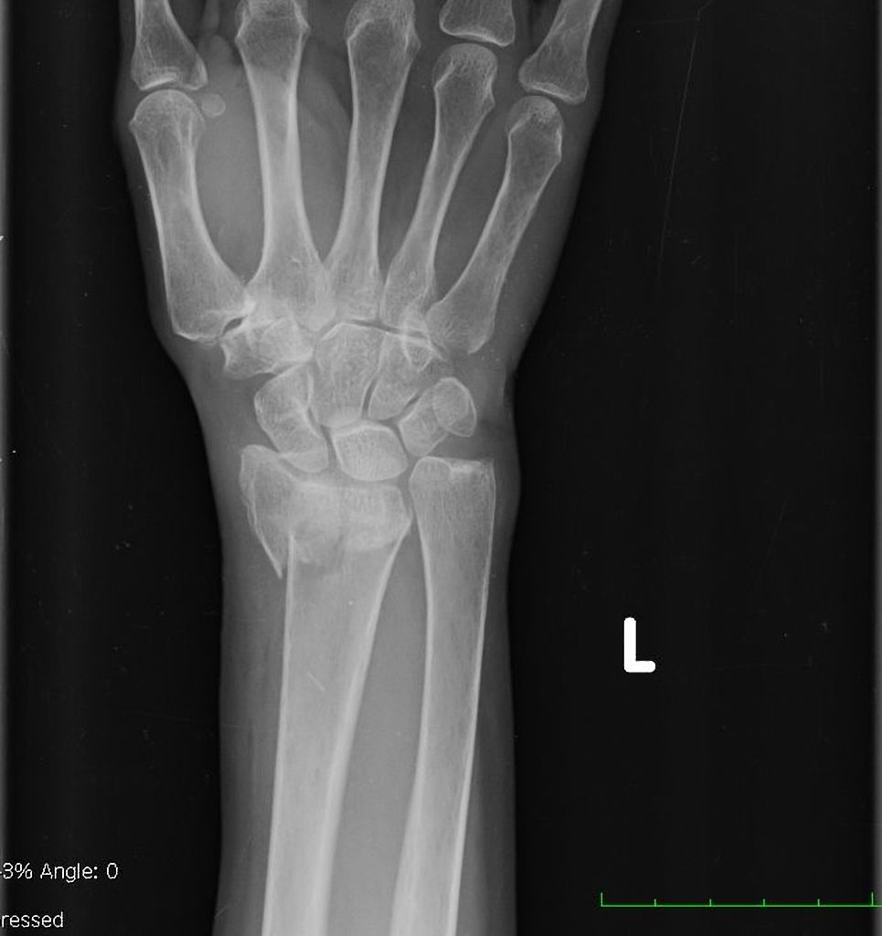 <p>posteroanterior hand radiograph of a 63-year-old female who fell</p>