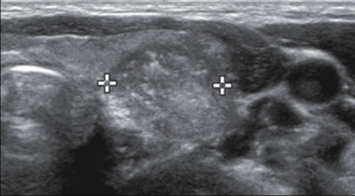 <p>b. Internal microcalcifications</p>