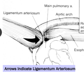 <ul><li><p><span style="background-color: transparent;"><strong><span>Et:</span></strong><span> </span></span><span style="background-color: transparent; color: red;"><strong><u><span>vascular ring traps esophagus, constriction near heart base</span></u></strong></span></p></li><li><p><span style="background-color: transparent;"><strong><span>Sig: </span></strong><span>Young <6m, onset at </span><u><span>weaning</span></u></span></p></li><li><p><span style="background-color: transparent;"><strong><span>Cs: regurg.</span></strong></span></p><ul><li><p><span style="background-color: transparent;"><strong><span>solids > liquids</span></strong></span></p></li></ul></li><li><p><span style="background-color: transparent;"><strong><span>Dt:</span></strong><span> </span><strong><u><span>thoracic rads, contrast esophagram or CT</span></u></strong></span></p></li><li><p><span style="background-color: transparent;"><strong><span>Tx:</span></strong><span> Sx</span></span></p></li><li><p><span style="background-color: transparent;"><strong><span>Comp:</span></strong><span> residual dilation when delayed</span></span></p></li></ul><img src="https://knowt-user-attachments.s3.amazonaws.com/3ec96af2-d9de-4078-a925-3b7378243685.png" data-width="50%" data-align="center"><p></p>